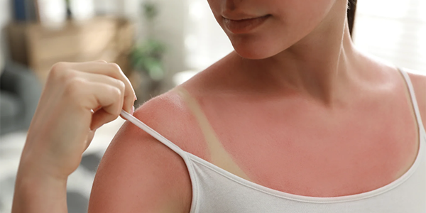 How to Heal a Sunburn Fast without Peeling