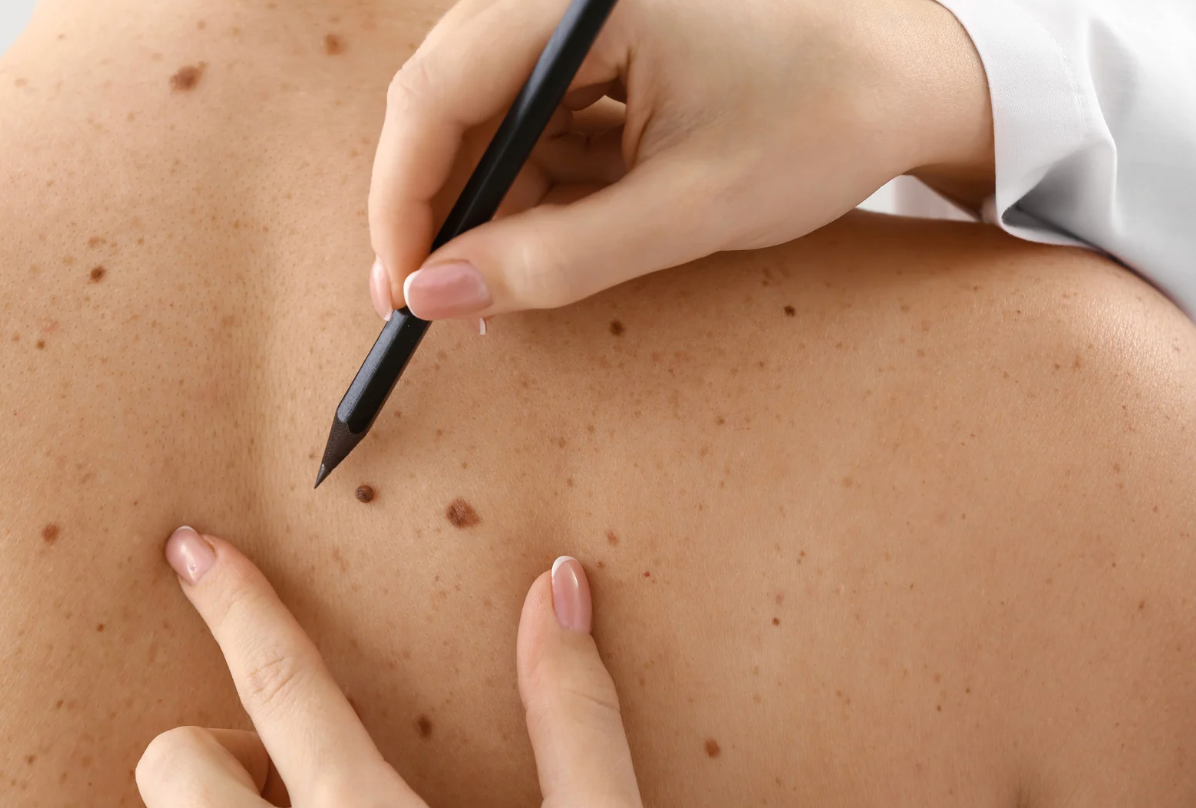 What Does Skin Cancer Look Like?
