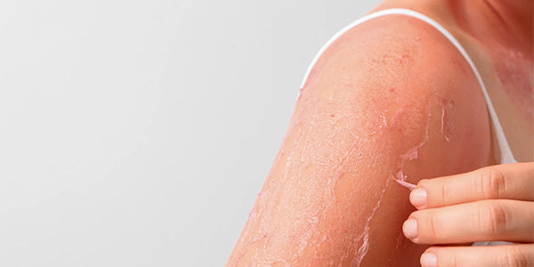 What is Sun Poisoning and How Do You Treat It?